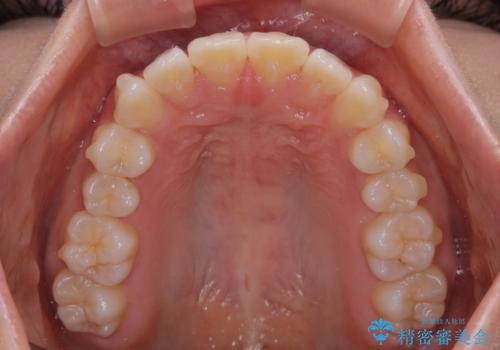 深い咬み合わせによる隙間 インビザライン矯正でコンプレックスを改善の治療中