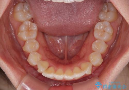 深い咬み合わせによる隙間 インビザライン矯正でコンプレックスを改善の治療中