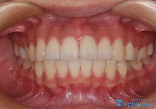 唇を閉じて眠れない ワイヤー装置での抜歯矯正で口元をスッキリとの治療前