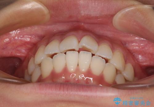 唇を閉じて眠れない ワイヤー装置での抜歯矯正で口元をスッキリとの治療前