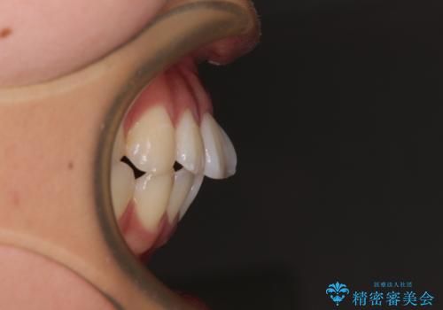 唇を閉じて眠れない ワイヤー装置での抜歯矯正で口元をスッキリとの治療前