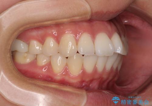 唇を閉じて眠れない ワイヤー装置での抜歯矯正で口元をスッキリとの治療前