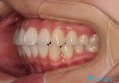 唇を閉じて眠れない ワイヤー装置での抜歯矯正で口元をスッキリとの治療前