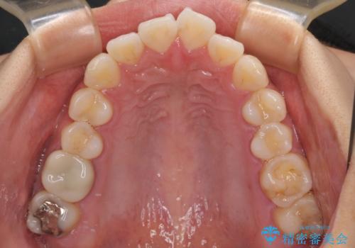 唇を閉じて眠れない ワイヤー装置での抜歯矯正で口元をスッキリとの治療前