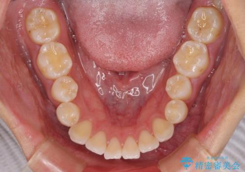 唇を閉じて眠れない ワイヤー装置での抜歯矯正で口元をスッキリとの治療前