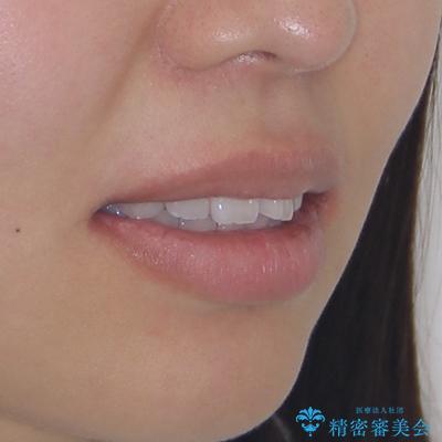 唇を閉じて眠れない ワイヤー装置での抜歯矯正で口元をスッキリとの治療前(顔貌)