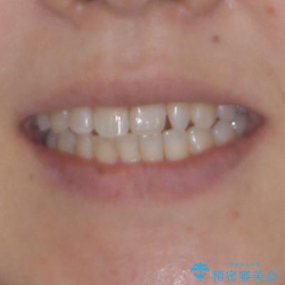 骨格的なズレを歯列矯正でカバー ワイヤー装置での非抜歯矯正の治療後(顔貌)
