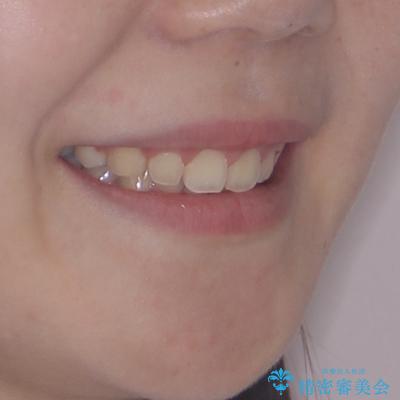 骨格的な出っ歯を抜歯矯正で改善 横顔の印象が劇的に変化の治療後(顔貌)