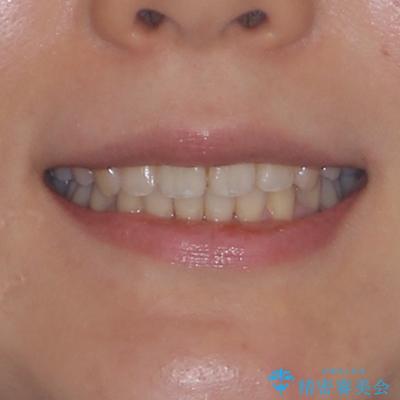 全顎的なデコボコと口元の突出感 ワイヤー装置での抜歯矯正で整った口元にの治療後(顔貌)