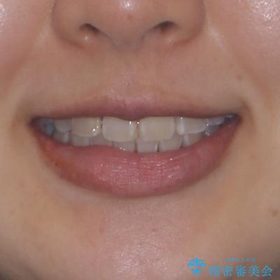 永久歯が埋もれて乳歯が残存 叢生改善のワイヤー抜歯矯正の治療後(顔貌)