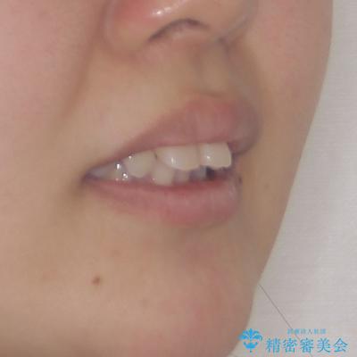 飛び出した口元を改善したい ワイヤー装置による抜歯矯正治療の治療前(顔貌)