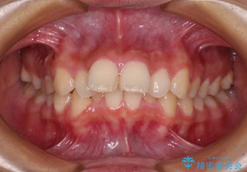 飛び出した口元を改善したい ワイヤー装置による抜歯矯正治療の症例 治療前