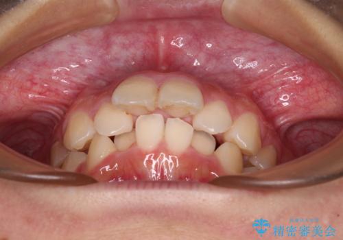 飛び出した口元を改善したい ワイヤー装置による抜歯矯正治療の治療前