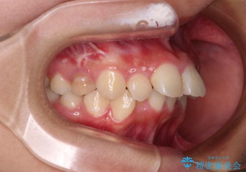 飛び出した口元を改善したい ワイヤー装置による抜歯矯正治療の治療前