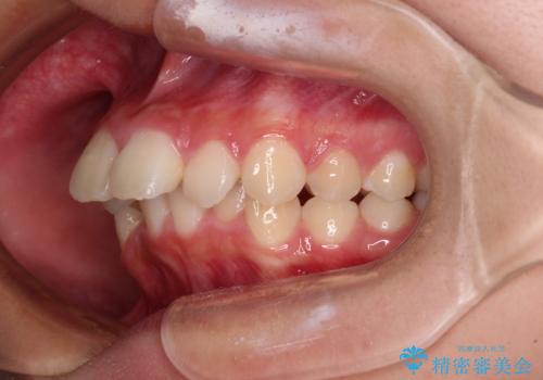 飛び出した口元を改善したい ワイヤー装置による抜歯矯正治療の治療前