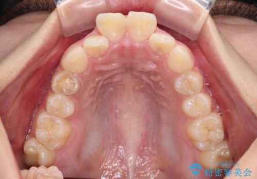 飛び出した口元を改善したい ワイヤー装置による抜歯矯正治療の治療前