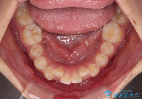 飛び出した口元を改善したい ワイヤー装置による抜歯矯正治療の治療前