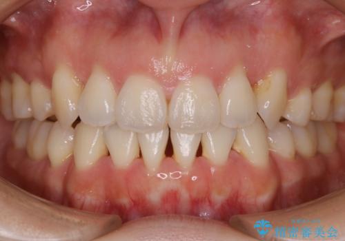 【抜歯】インビザラインの抜歯矯正の症例 治療後