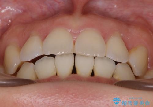 【抜歯】インビザラインの抜歯矯正の治療後