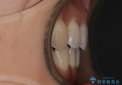 【抜歯】インビザラインの抜歯矯正の治療後