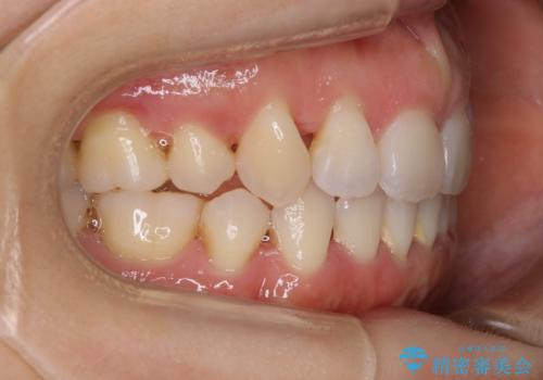 【抜歯】インビザラインの抜歯矯正の治療後