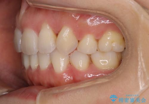 【抜歯】インビザラインの抜歯矯正