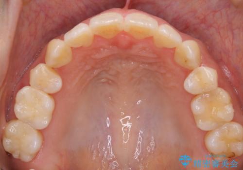 【抜歯】インビザラインの抜歯矯正の治療後