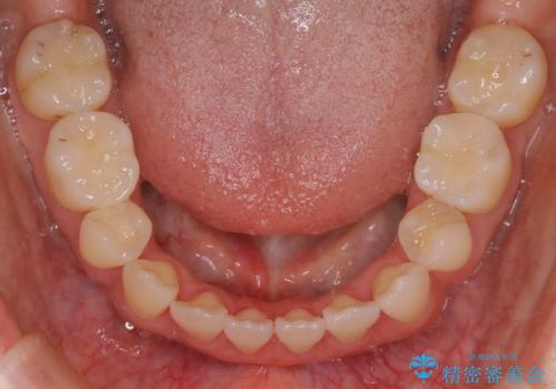 【抜歯】インビザラインの抜歯矯正の治療後