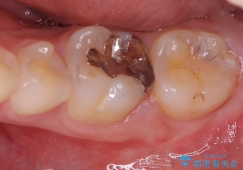 虫歯 〈セラミックインレー〉の治療前