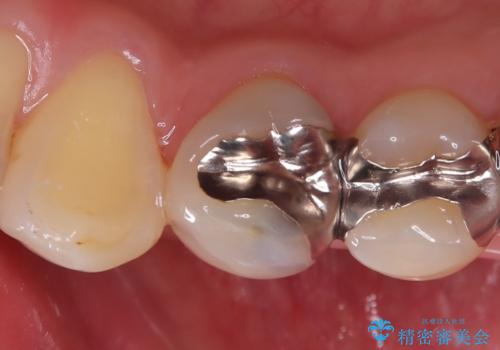 銀歯の下に虫歯 〈オールセラミッククラウン〉の治療前