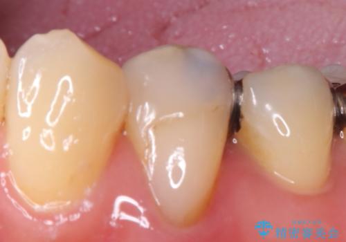 銀歯の下に虫歯 〈オールセラミッククラウン〉の治療前