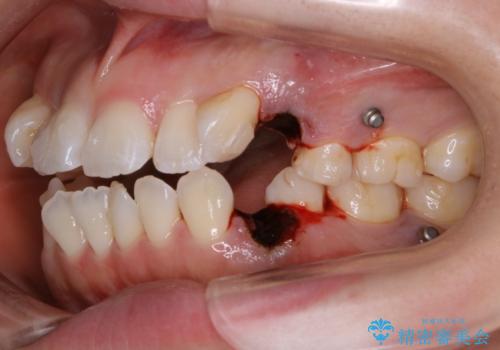 【抜歯】インビザラインの抜歯矯正の治療中