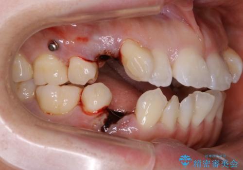 【抜歯】インビザラインの抜歯矯正の治療中