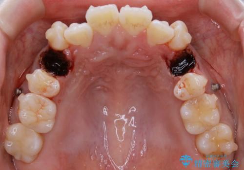 【抜歯】インビザラインの抜歯矯正の治療中