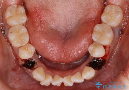 【抜歯】インビザラインの抜歯矯正の治療中