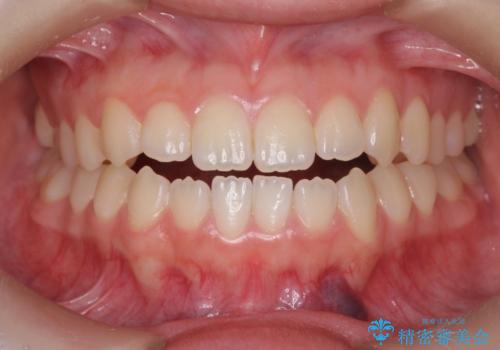 開咬(オープンバイト)の症例 治療前