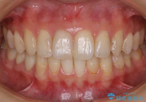 【非抜歯】歯を抜かずに歯列をコンパクトに!の治療後