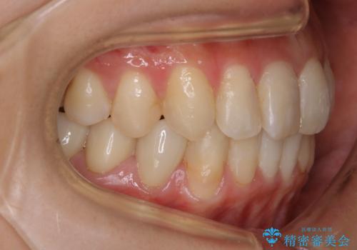 【非抜歯】歯を抜かずに歯列をコンパクトに!の治療後