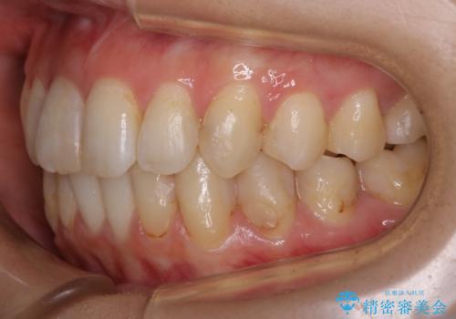 【非抜歯】歯を抜かずに歯列をコンパクトに!の治療後