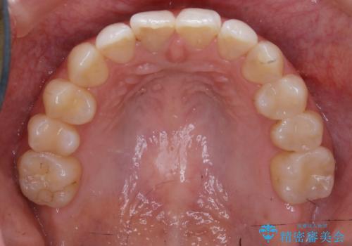 【非抜歯】歯を抜かずに歯列をコンパクトに!の治療後