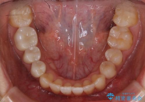 【非抜歯】歯を抜かずに歯列をコンパクトに!の治療後