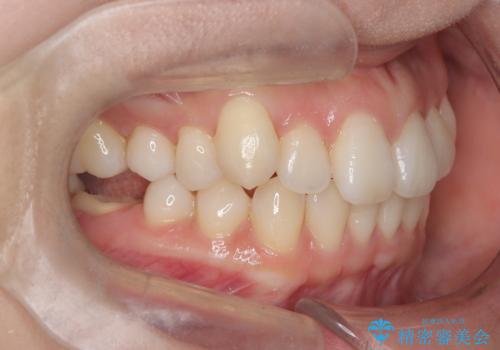 非抜歯矯正で八重歯を改善|短期間8か月で美しい歯並びに|インビザラインライト上顎のみで矯正の治療前