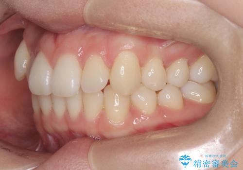 非抜歯矯正で八重歯を改善|短期間8か月で美しい歯並びに|インビザラインライト上顎のみで矯正の治療前