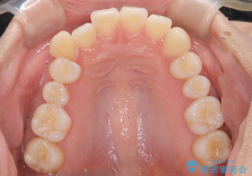 非抜歯矯正で八重歯を改善|短期間8か月で美しい歯並びに|インビザラインライト上顎のみで矯正の治療前