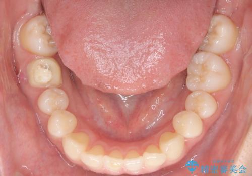 非抜歯矯正で八重歯を改善|短期間8か月で美しい歯並びに|インビザラインライト上顎のみで矯正の治療前