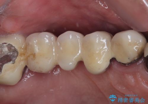 ぐらぐらする奥歯 短期間インプラント治療の症例 治療前