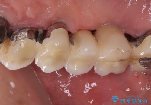 ぐらぐらする奥歯 短期間インプラント治療の治療前
