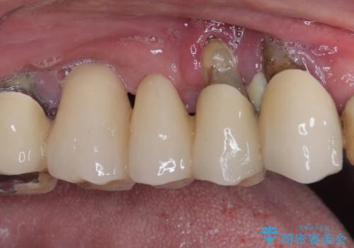 ぐらぐらする奥歯　短期間インプラント治療