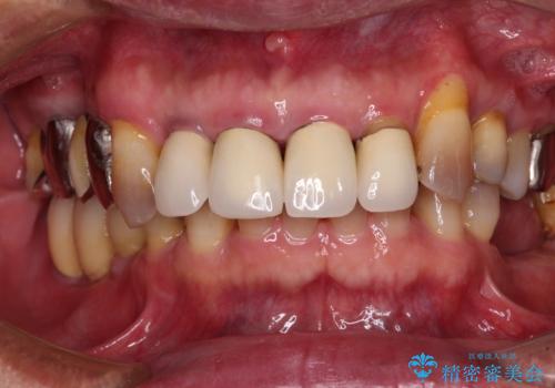 強い咬合力で奥歯がボロボロに インプラント治療による咬合回復と全顎セラミック治療