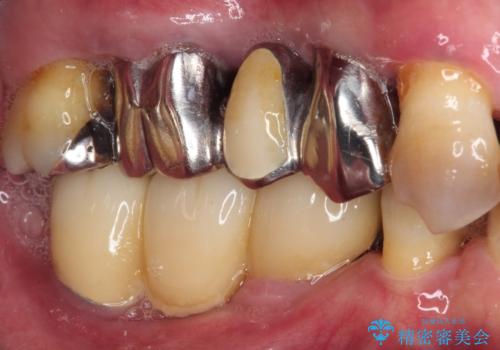 強い咬合力で奥歯がボロボロに インプラント治療による咬合回復と全顎セラミック治療の治療前